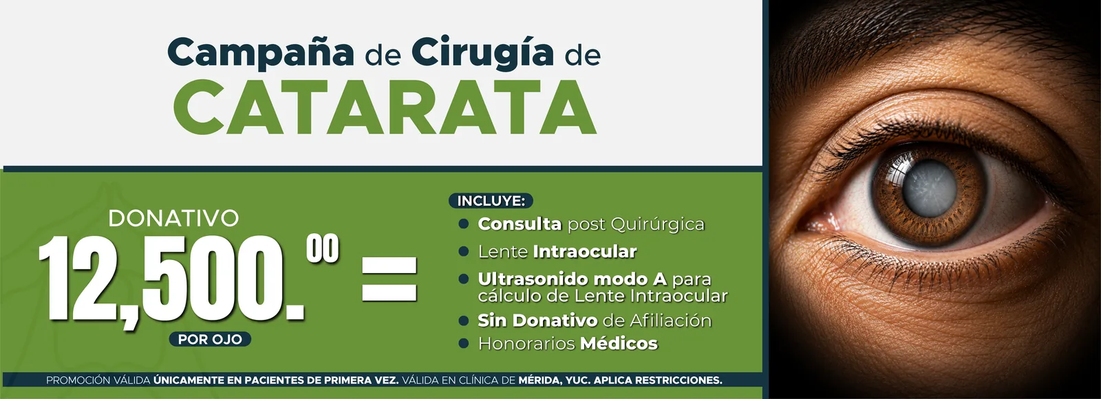 Campaña de cirugía de catarata en la clínica de Mérida, Yucatán. Donativo $12,500 por ojo. Incluye consulta posquirúrgica, lente intraocular, ultrasonido modo A, sin donativo de afiliación y honorarios médicos. Solo pacientes de primera vez.
