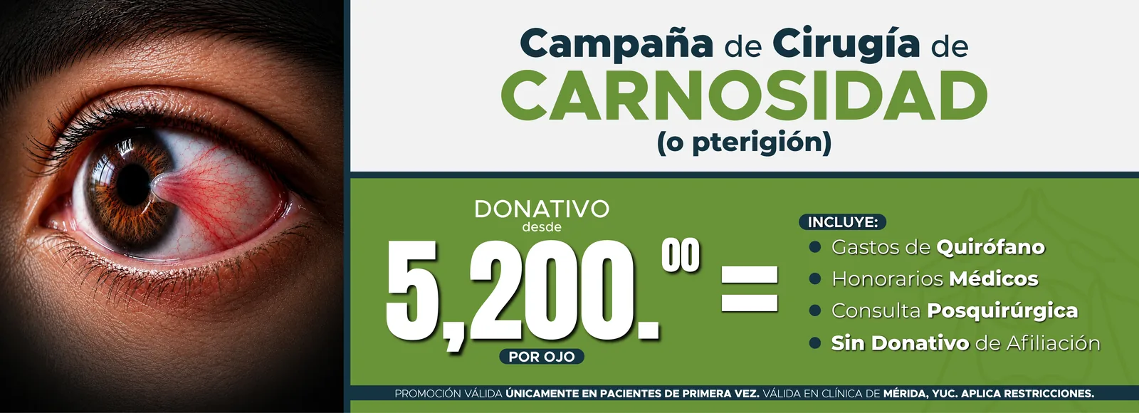 Campaña de cirugía de carnosidad (o pterigión) en la clínica de Mérida, Yucatán. Donativo desde $5,200 por ojo. Incluye gastos de quirófano, honorarios médicos, consulta posquirúrgica y sin donativo de afiliación. Solo pacientes de primera vez.